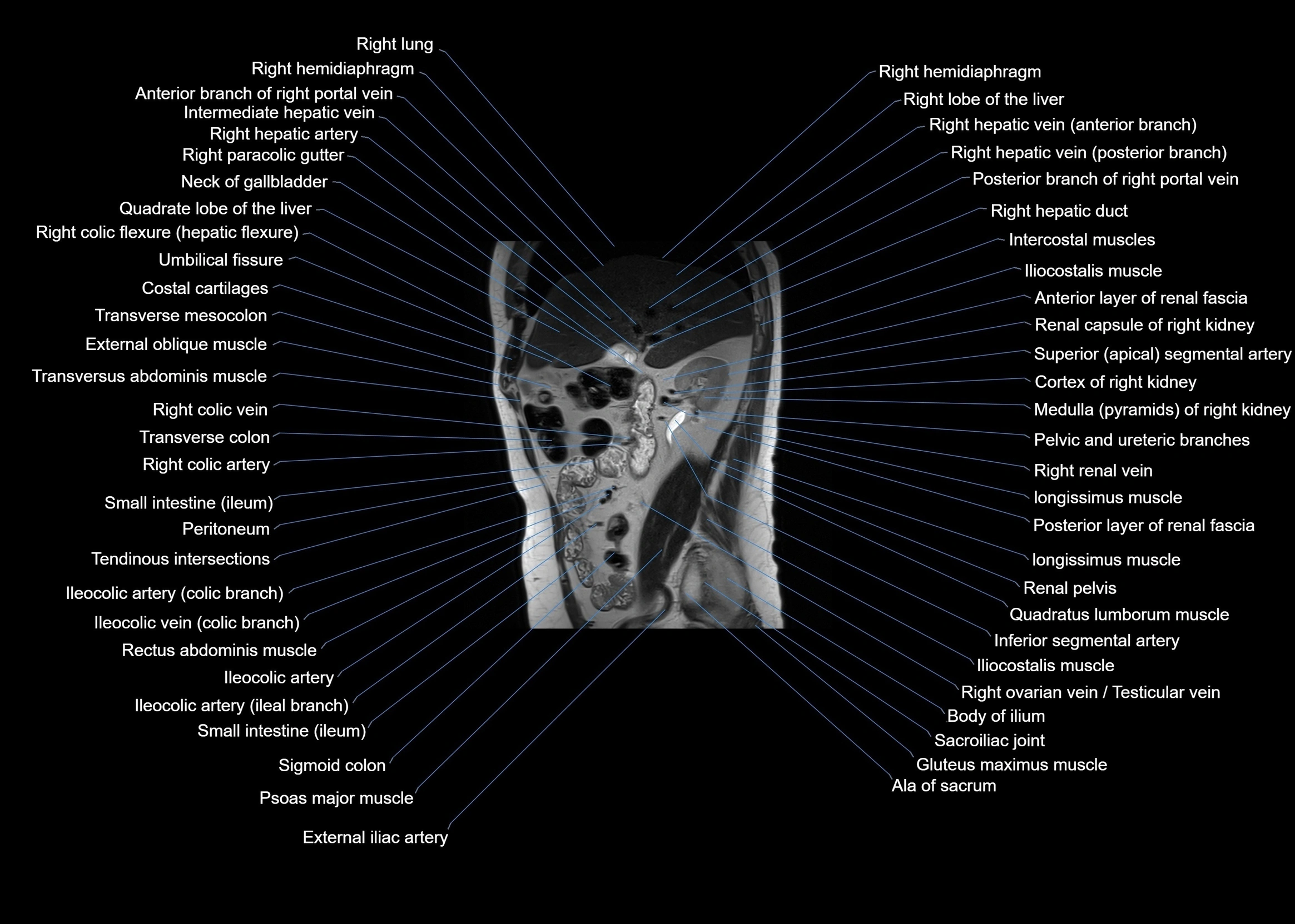 MRI abdomen sagittal cross sectional anatomy  radiology  image-img-00001-00027.webp